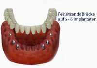 Frontzahnimplantat Aufbau